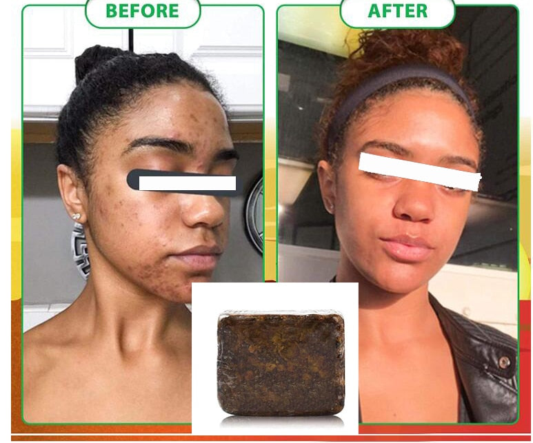 African Black Soap Treatment Acne