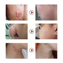 LANBENA Scar Removal Cream